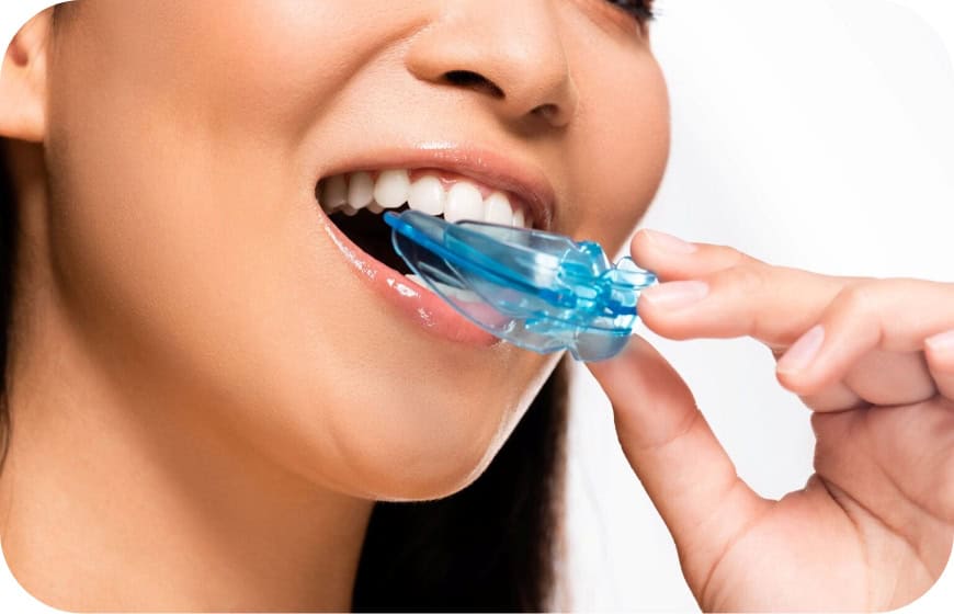 Person using a blue mouthguard for dental protection or whitening treatment.